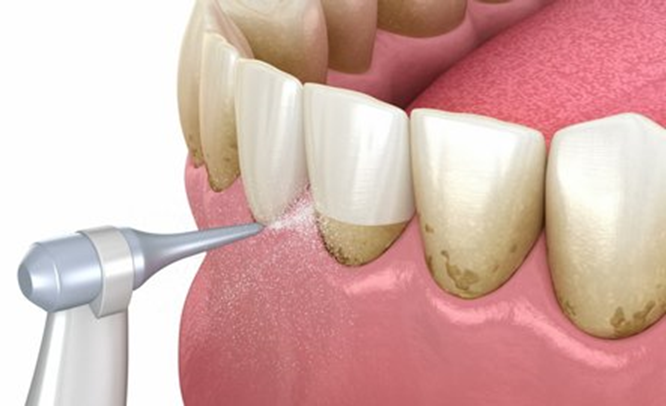 WHAT REALLY HAPPENS DURING DENTAL SCALLING
