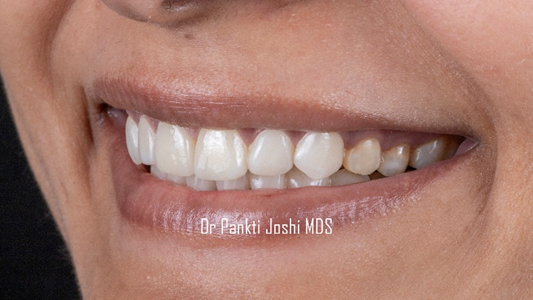 ‘‘Say Cheese with Confidence: Veneers Explained’’