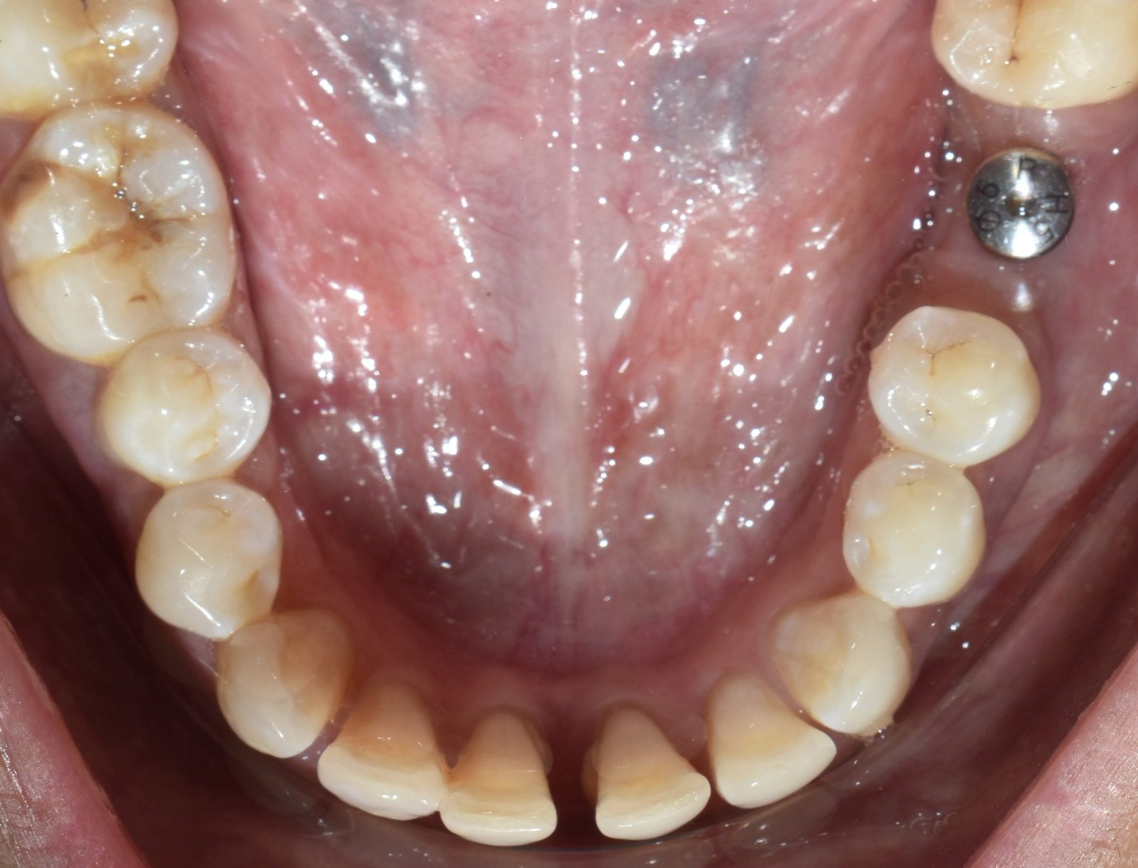 Dental Implants: The Ultimate Solution for Multiple Tooth Loss