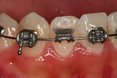 Orthodontic Emergencies: What to Do If a Bracket Breaks