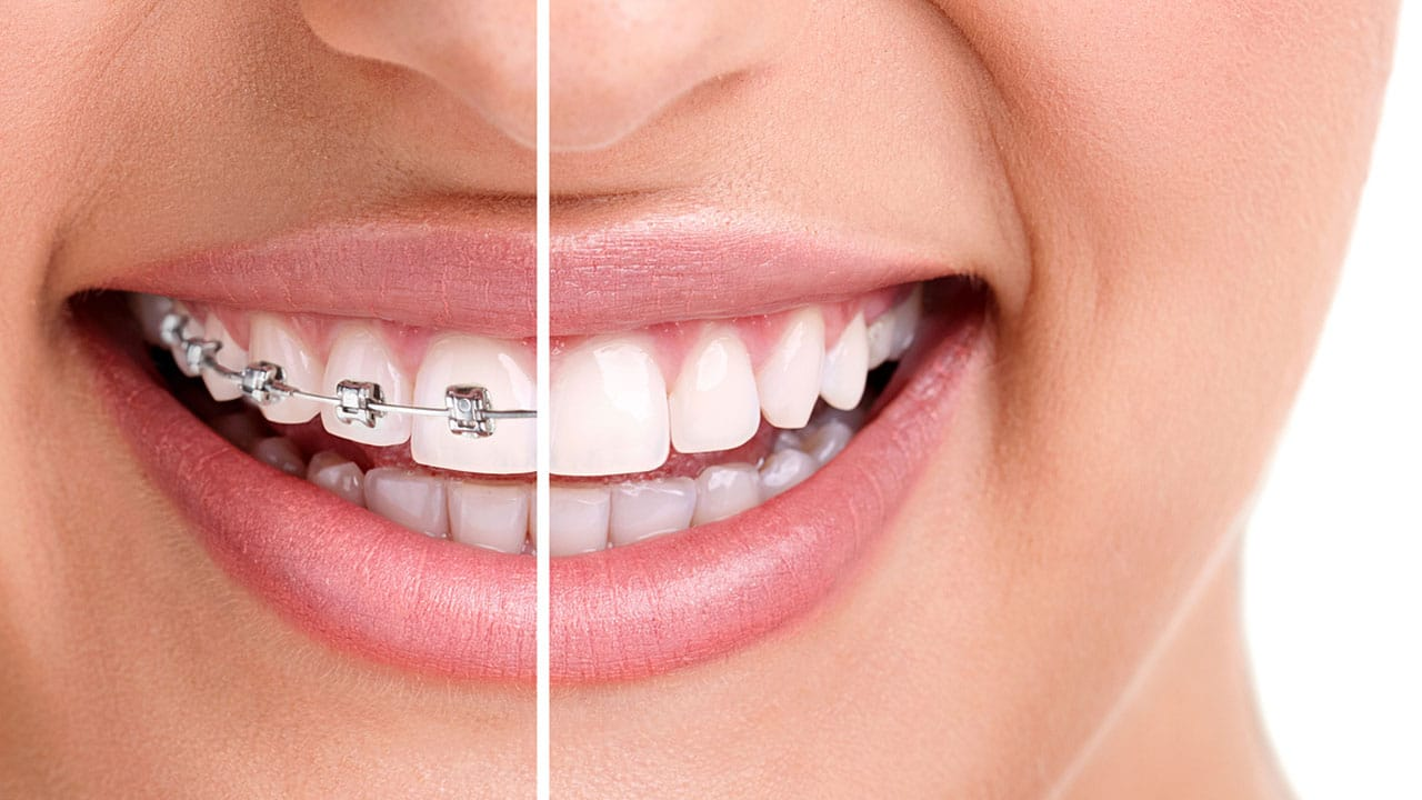 Is It Normal for Teeth to Feel Sore After Braces Removal?