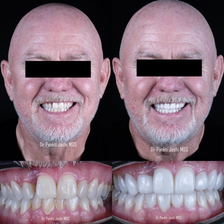 Smile story prostho 4 (1)