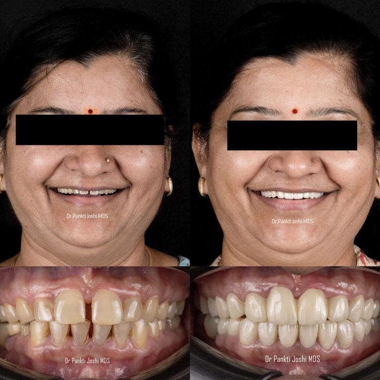 Smile story prostho 6