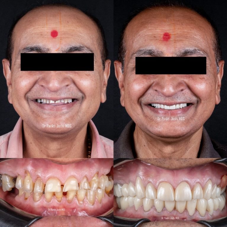 Smile story prostho 7