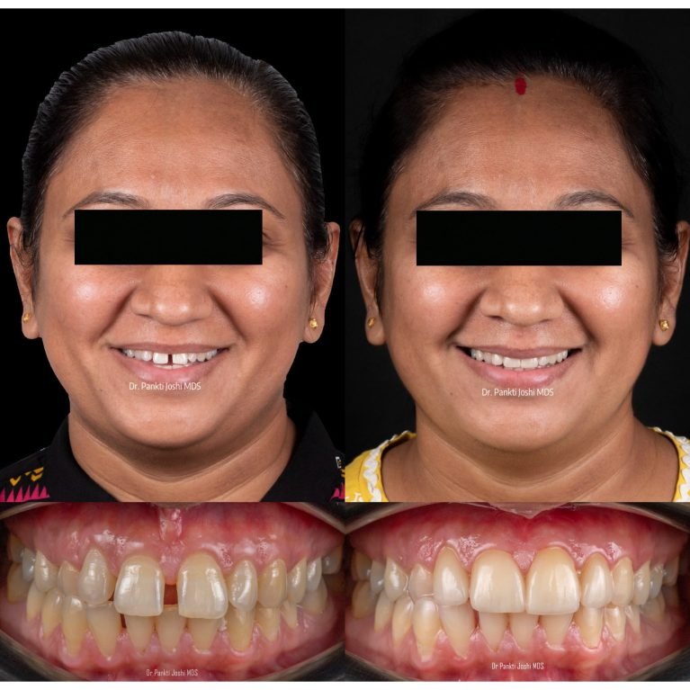 Smile story prostho 8